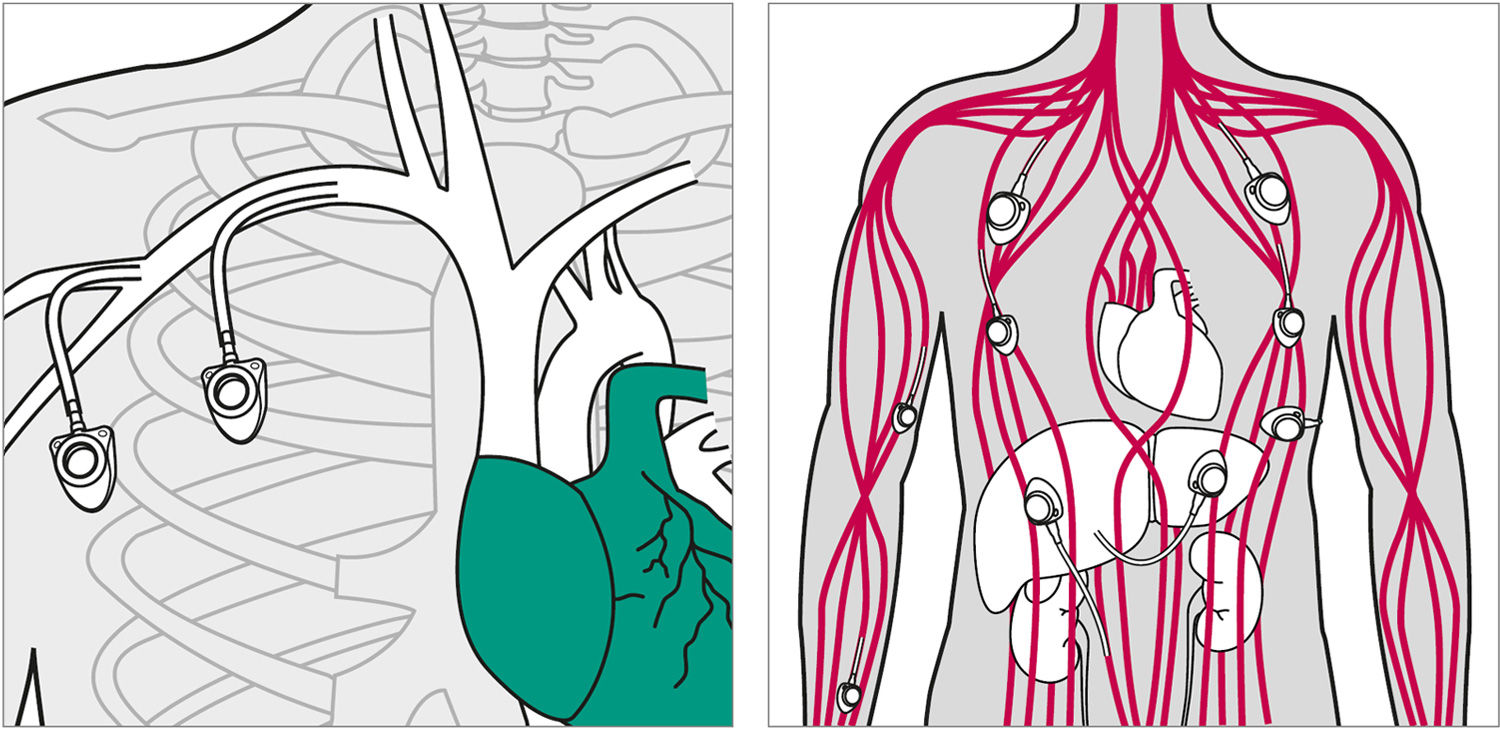 Illustrazioni delle potenziali vie di accesso per un catetere per porta vascolare venosa centrale