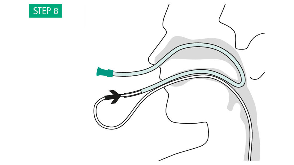 Illustrazioni: Collegare il drenaggio al tubo gastrico di fronte alla bocca. Tirare indietro il sondino gastrico insieme al drenaggio attraverso il naso.