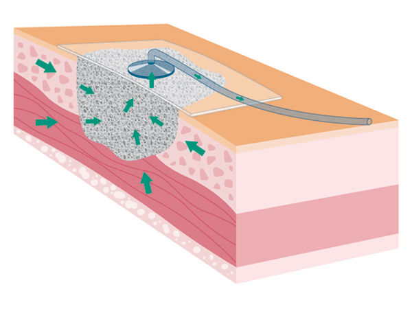 Illustrazione dell'applicazione della terapia sottovuoto endoluminale