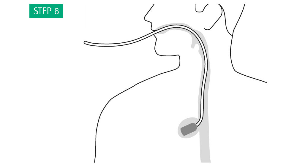 Illustrazioni: La spugna si espanderà nella cavità di fuoriuscita. Controllare la posizione della spugna con l'endoscopio per assicurarsi che la spugna non si sia spostata e, se necessario, correggerla con pinze di presa endoscopiche.