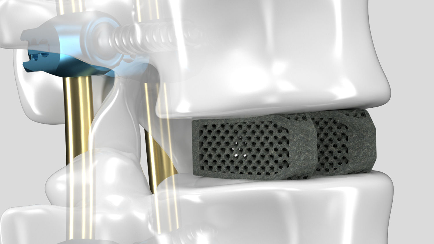 Modello spinale con Ennovate® e cage 3D