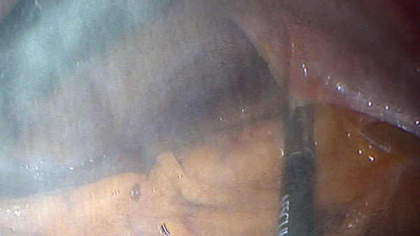 EinsteinVision® nella chirurgia laparoscopica con riduzione del fumo