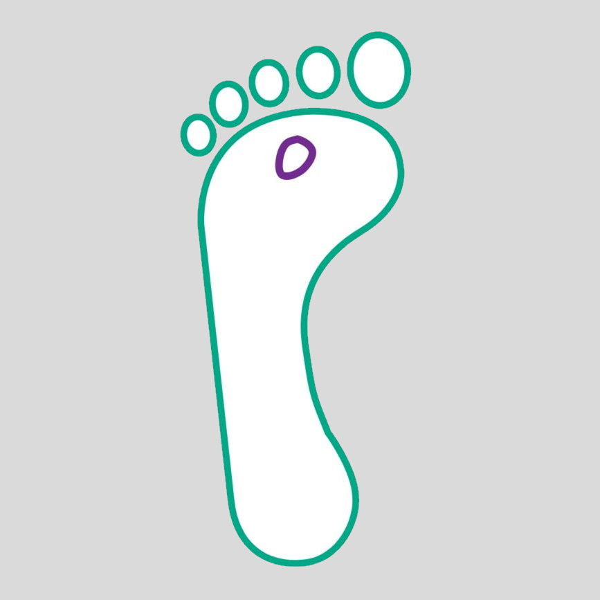 illustrazione dell'ulcera del piede diabetico di grado 1
