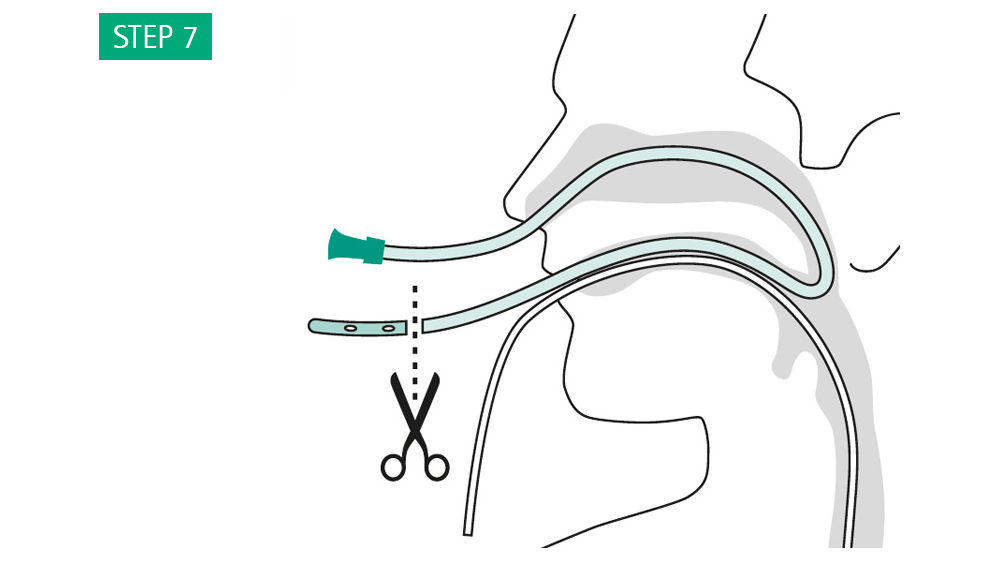 Illustrazioni: Canalizzazione transnasale - Inserire un tubo gastrico da 16 CH attraverso il naso e farlo uscire attraverso la bocca. Tagliare la punta atraumatica.