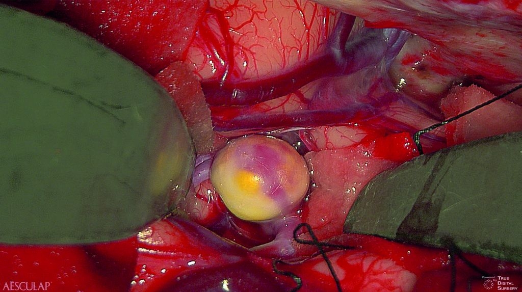 Aneurisma luce bianca