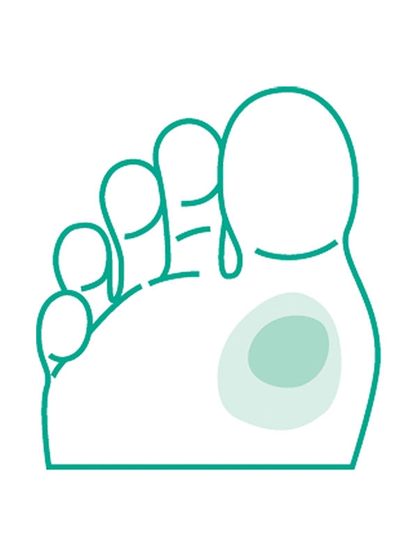 Foot icon with highlighted area on the foot's sole , indicating ulcer location.