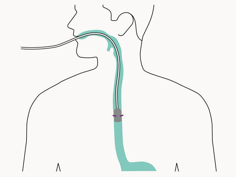 Illustrazione dell'uso preventivo di Eso-SPONGE®