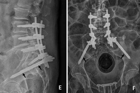 Radiografie della colonna vertebrale con impianti