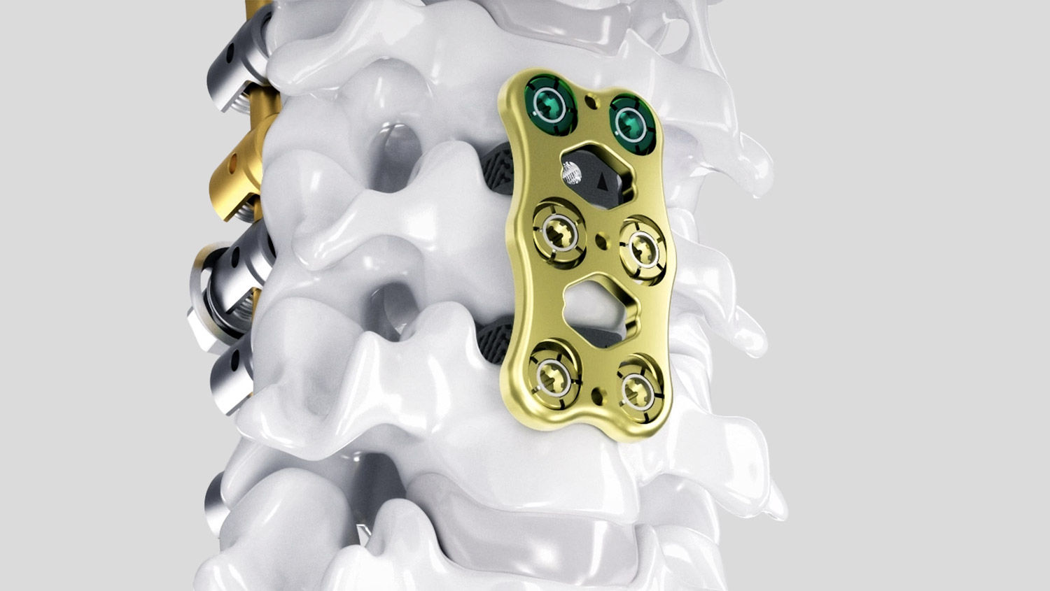 Ennovate® Cervical con AESCULAP® CeSPACE® 3D e Quintex®