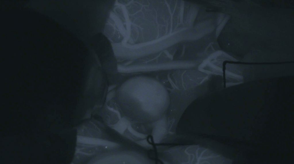 Fluorescenza ICG da aneurismi