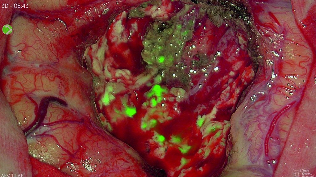 Luce bianca glioblastoma