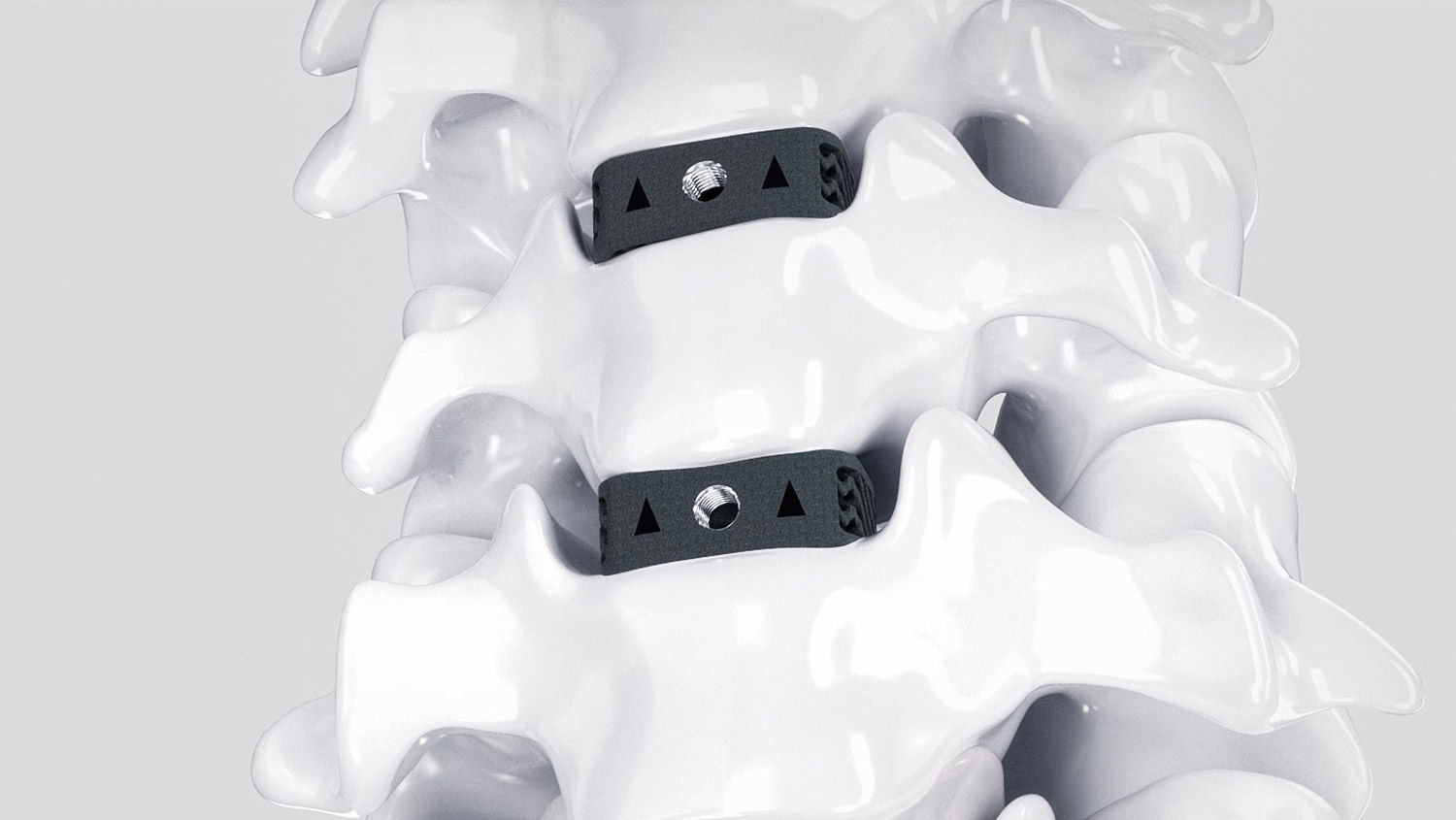 Modello spinale con Ennovate® e cage 3D