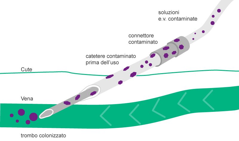 Illustration of Extra- and intraluminal route of contamination using a contaminated catheter.