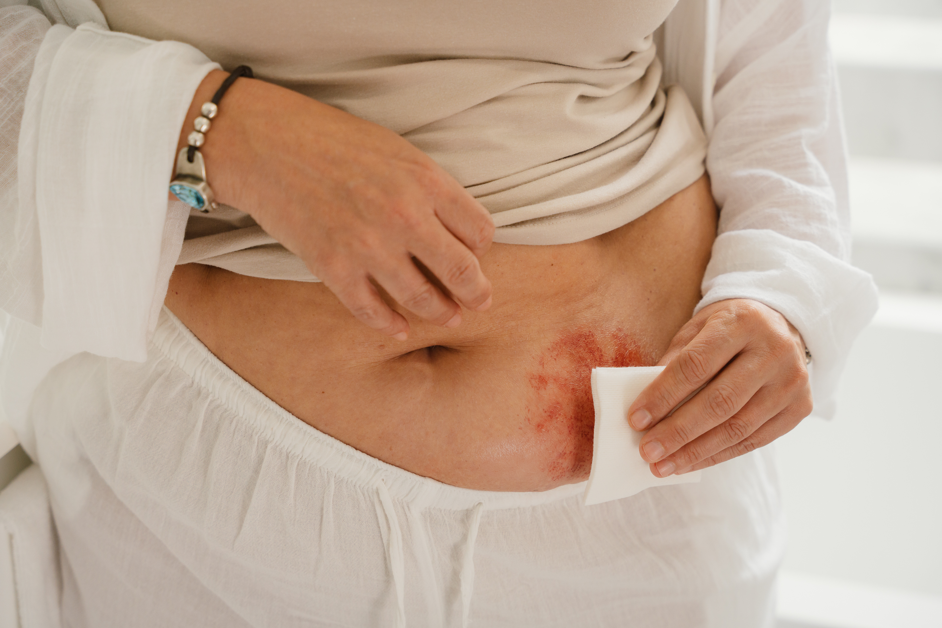 Primo piano di una persona con un'irritazione cutanea arrossata intorno alla stomia, che utilizza una garza medica bianca per detergere delicatamente la pelle peristomale sull'addome. La persona indossa abiti di colore chiaro e un braccialetto con perline al polso.
