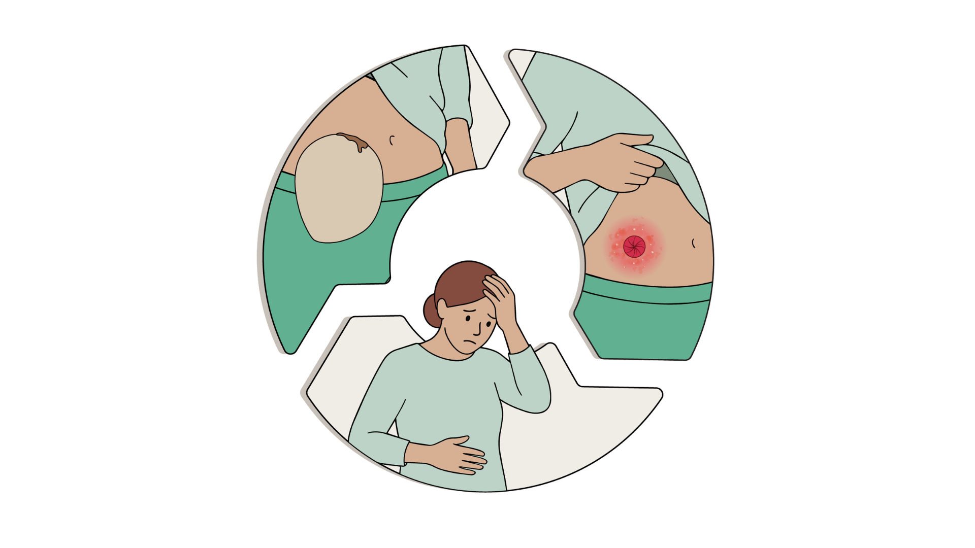 Illustrazione di un diagramma circolare che mostra il ciclo delle principali complicanze della stomia: la “Perdita dalla stomia” porta all'“Irritazione della pelle”, che a sua volta provoca un “Impatto negativo sulla qualità della vita”, rappresentato dall'immagine di una donna in difficoltà.