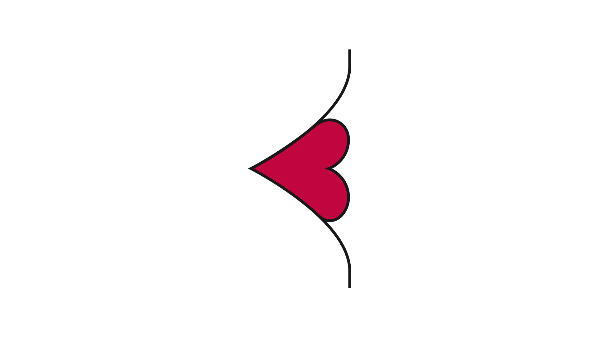 Illustrazione laterale di uno stoma in cui la pelle addominale circostante si incurva profondamente verso l’interno, creando una piega o un solco pronunciato a forma di V che comprime strettamente il tessuto rosso dello stoma.