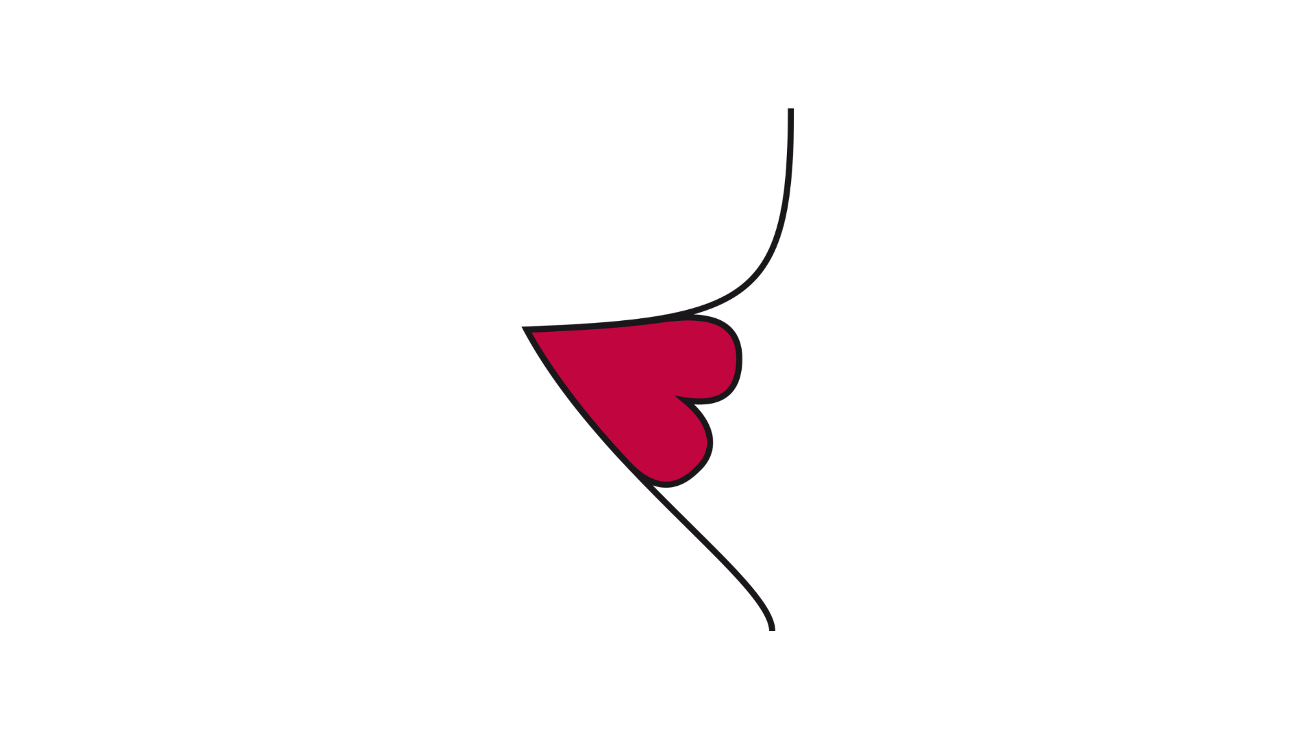Illustrazione laterale di uno stoma mal posizionato, in cui la linea della pelle addominale forma una piega o un solco profondo e irregolare, e lo stoma è collocato in modo sfavorevole all’interno di questa piega cutanea.