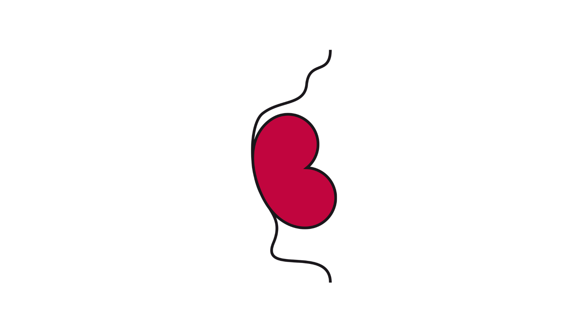 Illustrazione laterale di un addome morbido, in cui la parete addominale presenta un profilo ondulato e irregolare che sporge leggermente verso l’esterno, con lo stoma che segue i contorni morbidi e curvi della pelle.